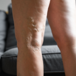 Gambe gonfie e pesanti