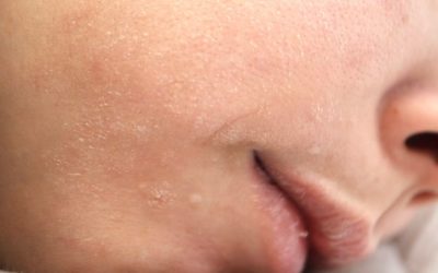 Pelle secca in inverno: cause e rimedi efficaci