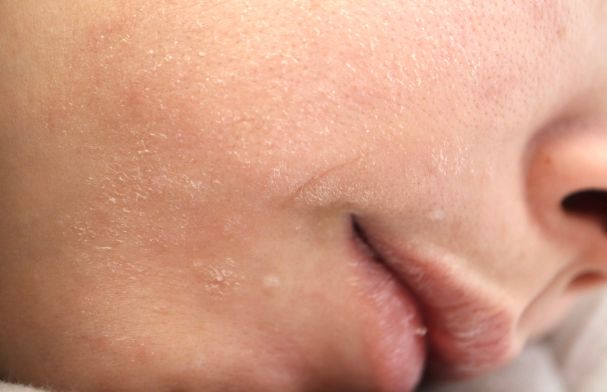 pelle-secca-in-inverno-cause-e-rimedi-efficaci