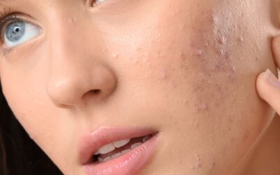 Acne adulta: perché peggiora con lo stress e il cambio stagione