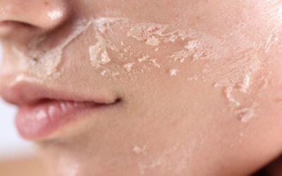 Pelle sensibile in primavera: come gestire rossi e reattività